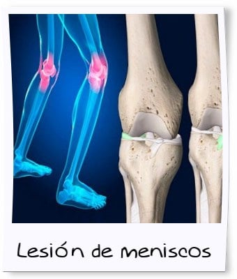 lesion de meniscos - dr rojo