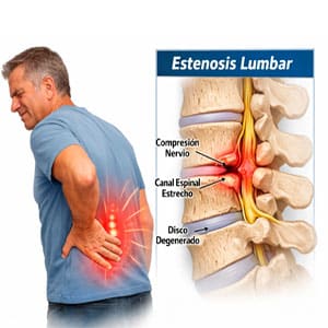 estenosis lumbar en ciudad obregon