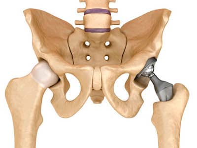 protesis de cadera en ciudad obregon
