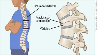 fractura de columna en obregon